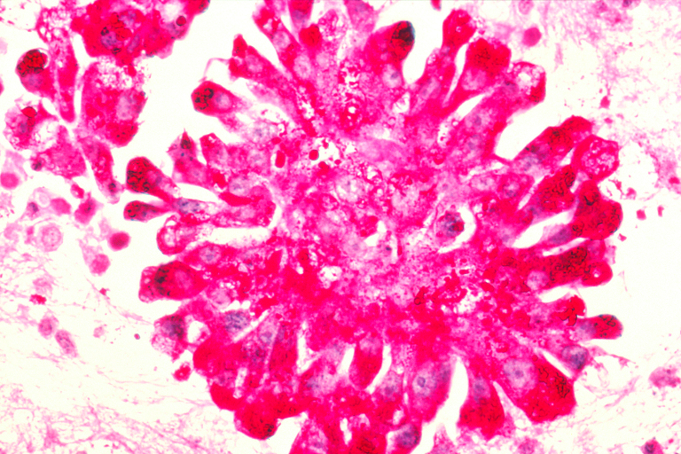 cancer cells